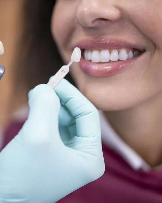 Matching a ceramic shade tab to a patient&rsquo;s smile